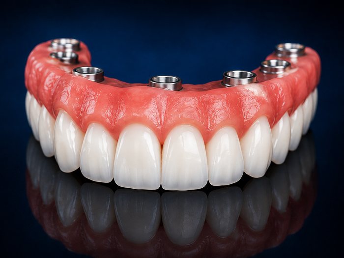 Prótese protocolo sobre múltiplos implantes